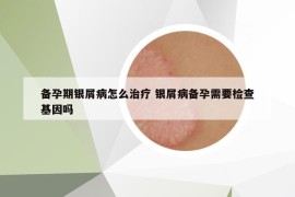 备孕期银屑病怎么治疗 银屑病备孕需要检查基因吗