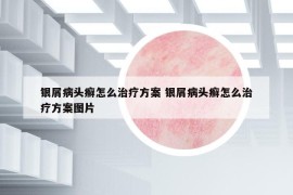 银屑病头癣怎么治疗方案 银屑病头癣怎么治疗方案图片