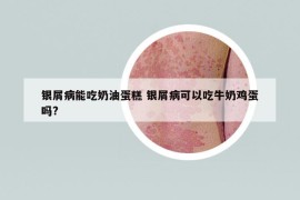 银屑病能吃奶油蛋糕 银屑病可以吃牛奶鸡蛋吗?