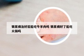 银屑病治好后能吃牛羊肉吗 银屑病好了能吃火锅吗