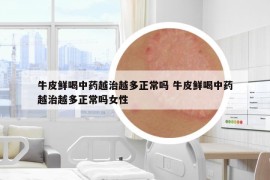 牛皮鲜喝中药越治越多正常吗 牛皮鲜喝中药越治越多正常吗女性