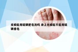 皮癣能用硫磺肥皂洗吗 身上长癣能不能用硫磺香皂