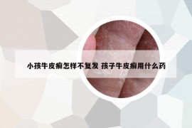 小孩牛皮癣怎样不复发 孩子牛皮癣用什么药
