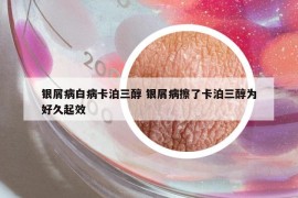 银屑病白病卡泊三醇 银屑病擦了卡泊三醇为好久起效