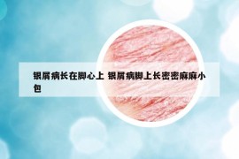 银屑病长在脚心上 银屑病脚上长密密麻麻小包