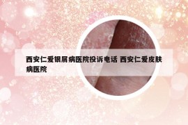 西安仁爱银屑病医院投诉电话 西安仁爱皮肤病医院