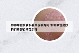 邯郸中信皮肤科看牛皮癣好吗 邯郸中信皮肤科门诊部口碑怎么样