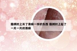 胳膊肘上长了像癣一样的东西 胳膊肘上起了一片一片的像癣