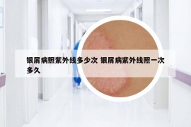 银屑病照紫外线多少次 银屑病紫外线照一次多久