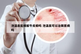 泡温泉能缓解牛皮癣吗 泡温泉可以治银屑病吗
