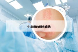 牛皮癣的所有症状