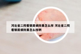 河北省二院看银屑病效果怎么样 河北省二院看银屑病效果怎么样啊