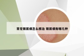 常见银屑病怎么根治 银屑病有哪几种