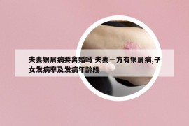 夫妻银屑病要离婚吗 夫妻一方有银屑病,子女发病率及发病年龄段