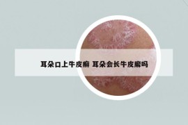 耳朵口上牛皮癣 耳朵会长牛皮廨吗