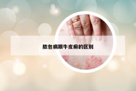 脓包病跟牛皮癣的区别