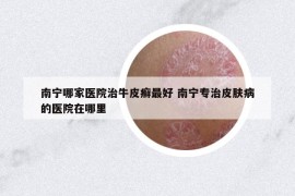 南宁哪家医院治牛皮癣最好 南宁专治皮肤病的医院在哪里