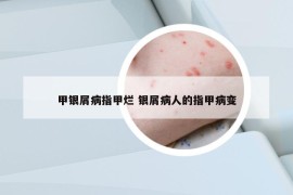 甲银屑病指甲烂 银屑病人的指甲病变