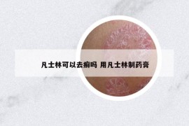 凡士林可以去癣吗 用凡士林制药膏