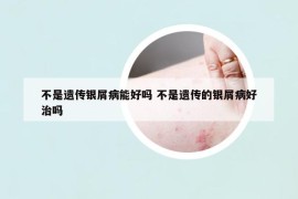 不是遗传银屑病能好吗 不是遗传的银屑病好治吗