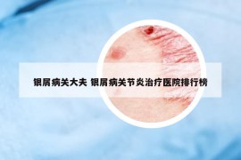银屑病关大夫 银屑病关节炎治疗医院排行榜