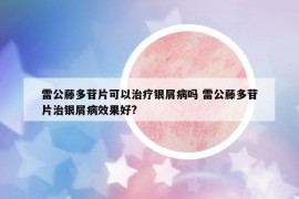 雷公藤多苷片可以治疗银屑病吗 雷公藤多苷片治银屑病效果好?