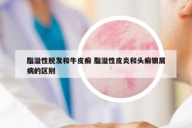 脂溢性脱发和牛皮癣 脂溢性皮炎和头癣银屑病的区别