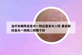 治疗白癜风选吉大一院还是吉大二院 看皮肤科吉大一院和二院哪个好