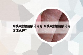 中央4套银屑病药浴方 中央4套银屑病药浴方怎么样?