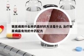 银屑病用什么中药最好的方法是什么 治疗银屑病最有效的中药配方