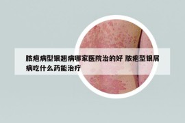 脓疱病型银翘病哪家医院治的好 脓疱型银屑病吃什么药能治疗