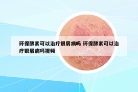 环保酵素可以治疗银屑病吗 环保酵素可以治疗银屑病吗视频
