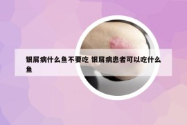 银屑病什么鱼不要吃 银屑病患者可以吃什么鱼