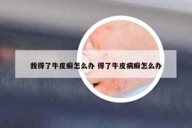 我得了牛皮癣怎么办 得了牛皮病癣怎么办