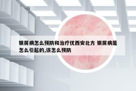 银屑病怎么预防和治疗优西安北方 银屑病是怎么引起的,该怎么预防
