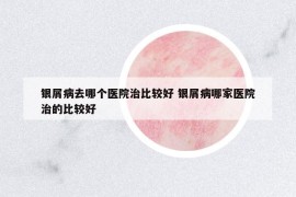 银屑病去哪个医院治比较好 银屑病哪家医院治的比较好