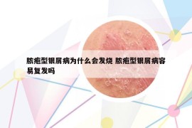 脓疱型银屑病为什么会发烧 脓疱型银屑病容易复发吗
