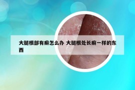 大腿根部有癣怎么办 大腿根处长癣一样的东西