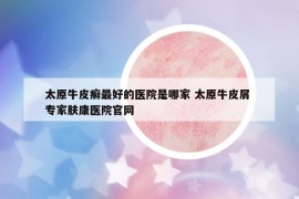 太原牛皮癣最好的医院是哪家 太原牛皮屑 专家肤康医院官网