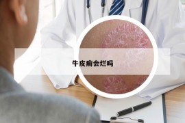牛皮癣会烂吗