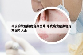 牛皮癣发病期稳定期图片 牛皮癣发病期稳定期图片大全