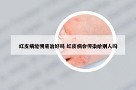 红皮病能彻底治好吗 红皮病会传染给别人吗
