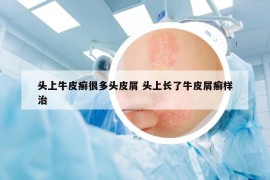 头上牛皮癣很多头皮屑 头上长了牛皮屑癣样治