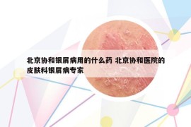 北京协和银屑病用的什么药 北京协和医院的皮肤科银屑病专家