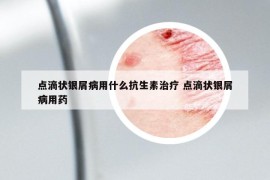 点滴状银屑病用什么抗生素治疗 点滴状银屑病用药