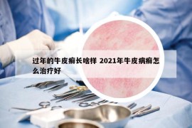 过年的牛皮癣长啥样 2021年牛皮病癣怎么治疗好