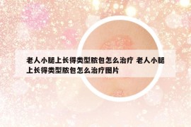 老人小腿上长得类型脓包怎么治疗 老人小腿上长得类型脓包怎么治疗图片