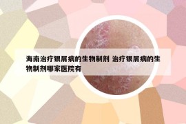 海南治疗银屑病的生物制剂 治疗银屑病的生物制剂哪家医院有