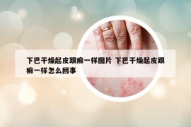 下巴干燥起皮跟癣一样图片 下巴干燥起皮跟癣一样怎么回事