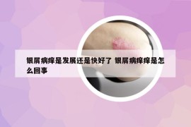 银屑病痒是发展还是快好了 银屑病痒痒是怎么回事